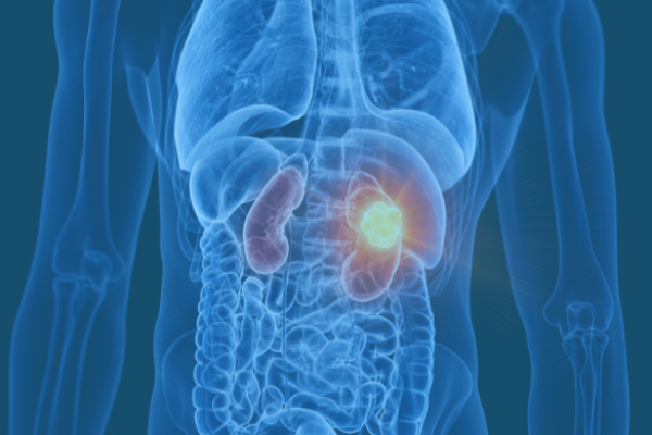 Kidney-Cancer-Location