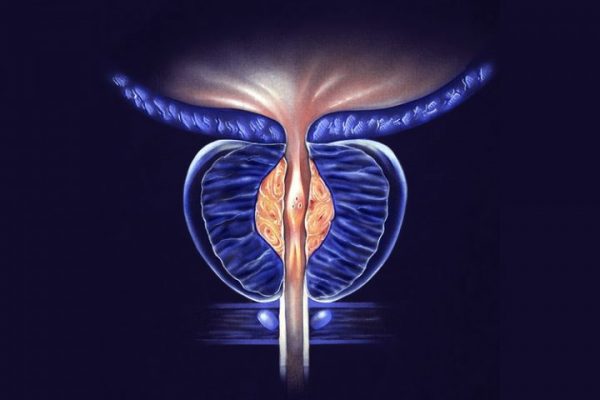 enlarged-prostate-768x480