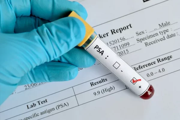 what-is-a-PSA-test_745x510_njaecd_288879df49