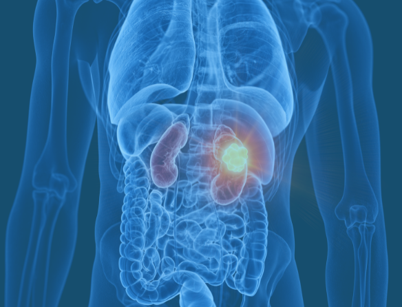 Kidney-Cancer-Location