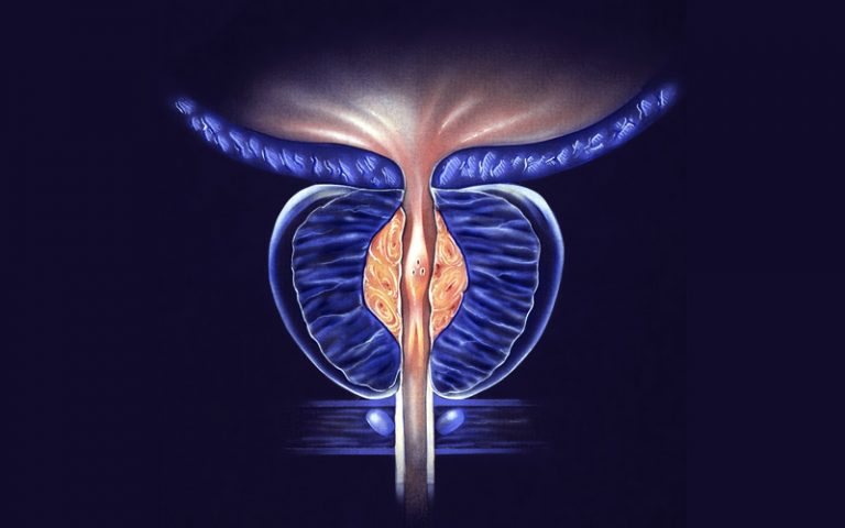 enlarged-prostate-768x480
