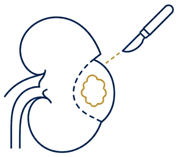 Illustration of partial nephrectomy removing a kidney tumour